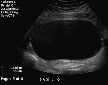 icd 10 code for left adnexal cystic structure